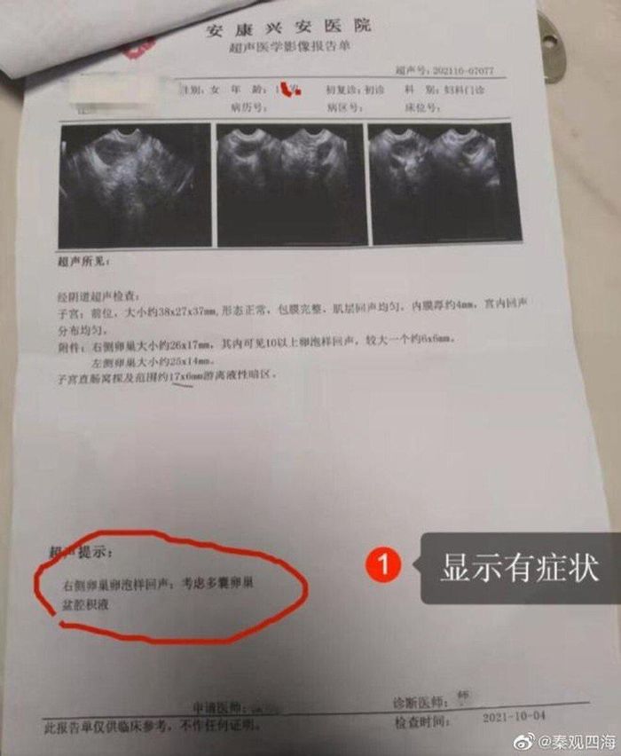  Hóa đơn Lu nhận được sau ca phẫu thuật. Cô gái còn bị yêu cầu gọi điện cho bạn bè để vay tiền. Ảnh: 163.com. 