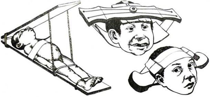 Vì vậy, các bậc cha mẹ thuộc tầng lớp thượng lưu, quý tộc và hoàng tộc thường dùng vải quấn chặt phần đầu hoặc dùng nẹp gỗ định hình hình dáng của hộp sọ trong vài năm.