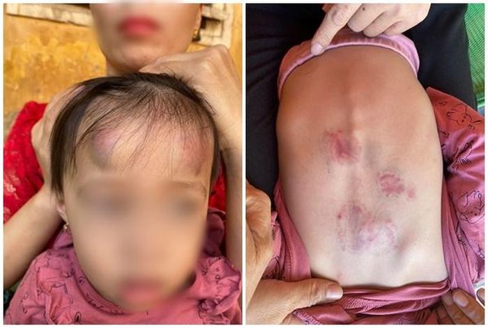  Hình ảnh cháu bé 22 tháng tuổi bị đánh thâm tím. 