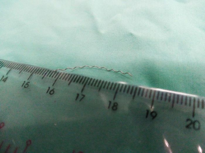 Dị vật trôi xuống vùng cổ cột sống của bé Kh. là cọng dây kẽm.