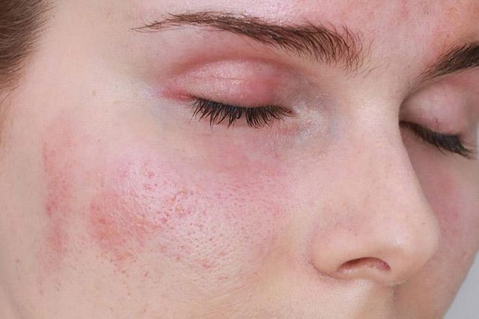 Rất có thể đây là nguyên nhân do các tế bào ung thư đang xâm nhập vào cơ thể, ảnh hưởng đến nội tiết, làm cho quá trình bài tiết các loại hormone trong cơ thể bị rối loạn nên mặt sẽ nổi mẩn đỏ bất thường.