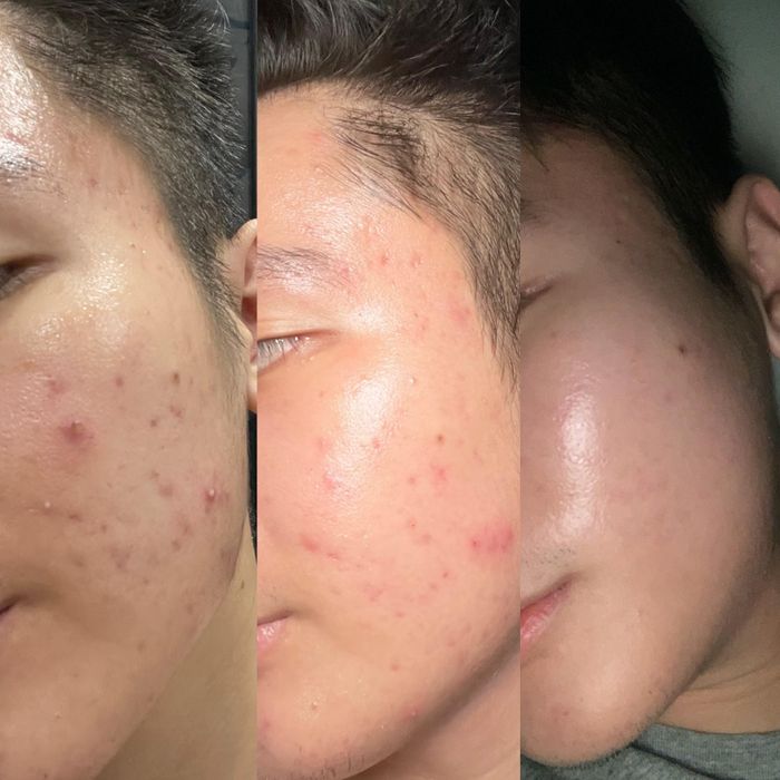  Do đặc thù công việc phải thử nhiều sản phẩm, da của Trần Lâm bị kích ứng và xuất hiện nhiều mụn. 