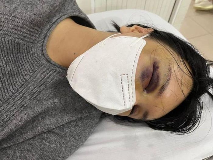 Khả Trang mắt đỏ ngầu, mũi như bị đánh gãy trong ảnh mới công bố