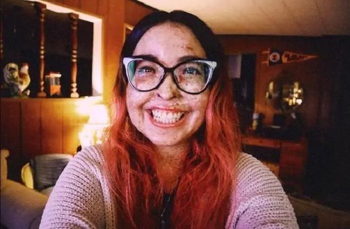 Căn bệnh hiếm gặp khiến cuộc sống của Andrea Ivonne Monroy bị ví như ma cà rồng.
