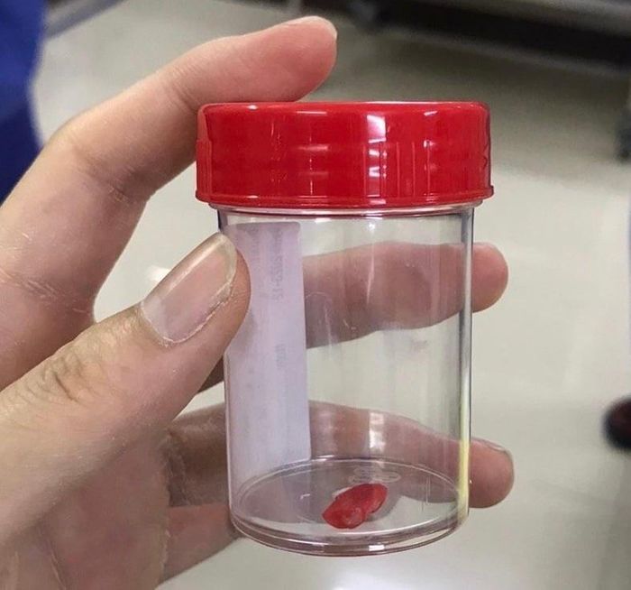 Dị vật lấy ra từ phế quản của trẻ. Ảnh: BVCC