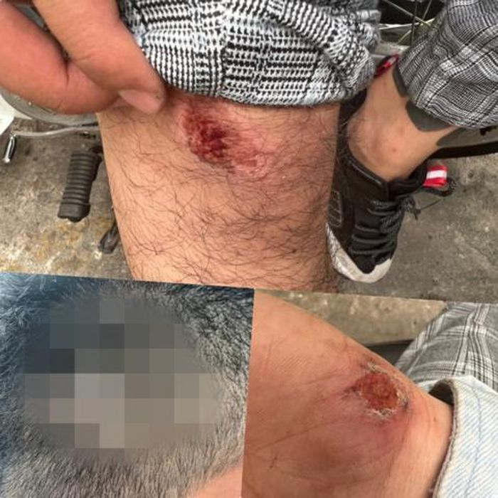 Thương tích để lại trên người anh A. sau khi bị tấn công bất ngờ