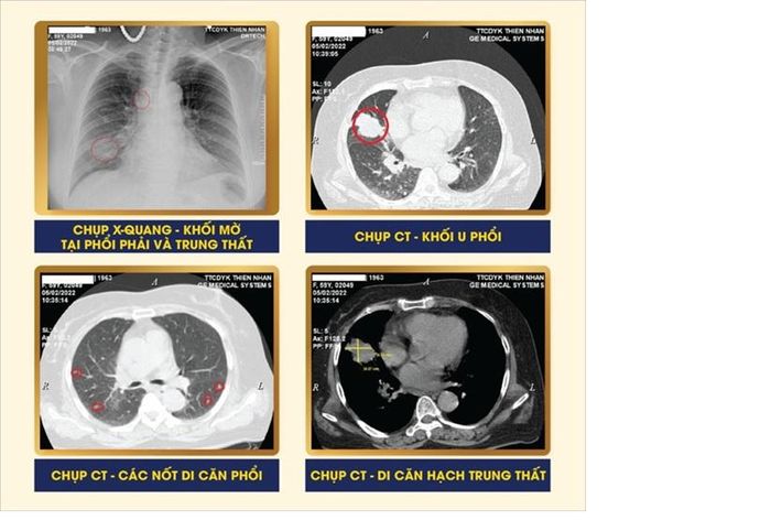 Hình ảnh chụp X-quang và chụp CT của bệnh nhân. Ảnh: Trung tâm Chẩn đoán y khoa kỹ thuật cao Thiện Nhân Đà Nẵng cung cấp