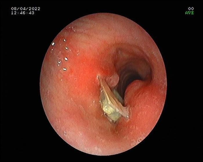 Dị vật nằm dọc khí quản gây biến dạng, phù nề
