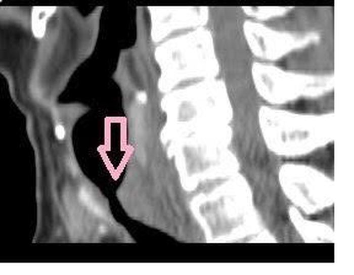 Hình ảnh dị vật ở khí quản (mũi tên vàng) trên CT ngực và gây phù nề và hẹp khí quản không hoàn toàn (mũi tên hồng)