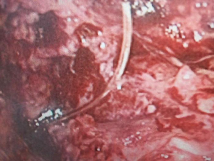 Chiếc xương cá xuyên thủng đại tràng được phát hiện trên hình ảnh camera phẫu thuật nội soi