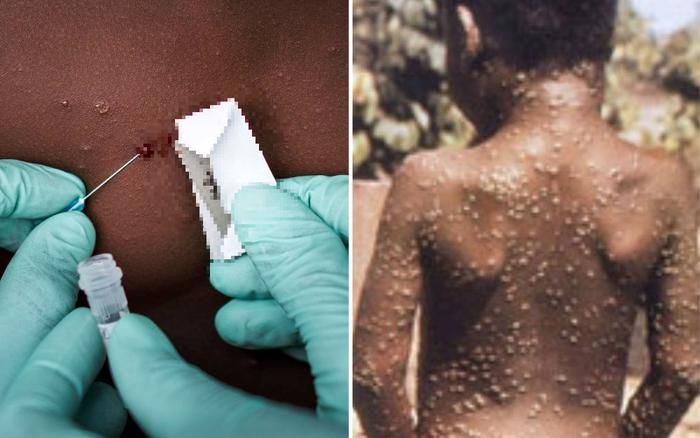 Lấy mẫu kiểm tra virus đậu mùa khỉ ở bệnh nhân nghi ngờ. Ảnh: Internet