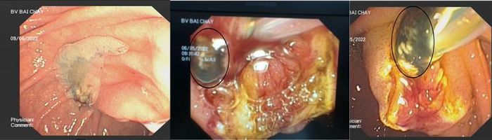 Sán lá gan trong ống mật chủ của bệnh nhân qua hình ảnh nội soi tụy mật ngược dòng ERCP tại Bệnh viện Bãi Cháy - Ảnh: BVCC