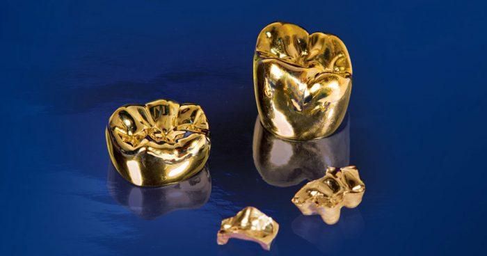 Bên cạnh đó, một số đại gia còn muốn đúc vàng nguyên khối bên trong chân răng. Ảnh minh họa