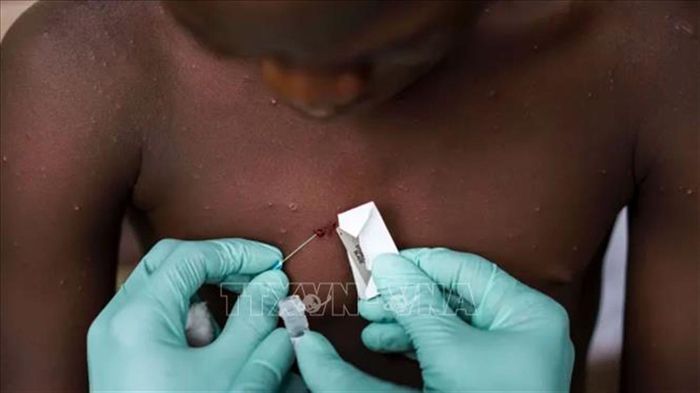 Bệnh đậu mùa khỉ đã tấn công trên 20 quốc gia