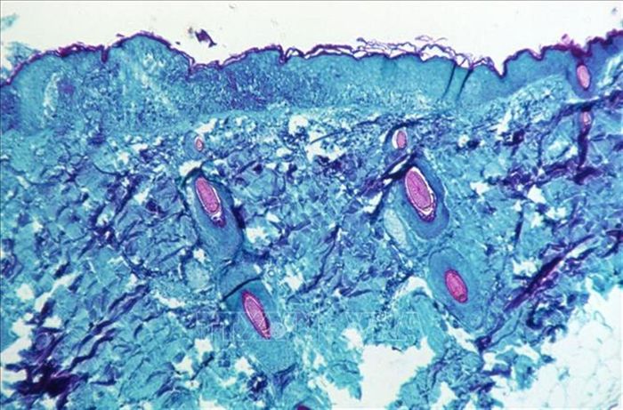 Một phần tế bào da của một con khỉ bị mắc bệnh đậu mùa khỉ. Ảnh: REUTER/TTXVN