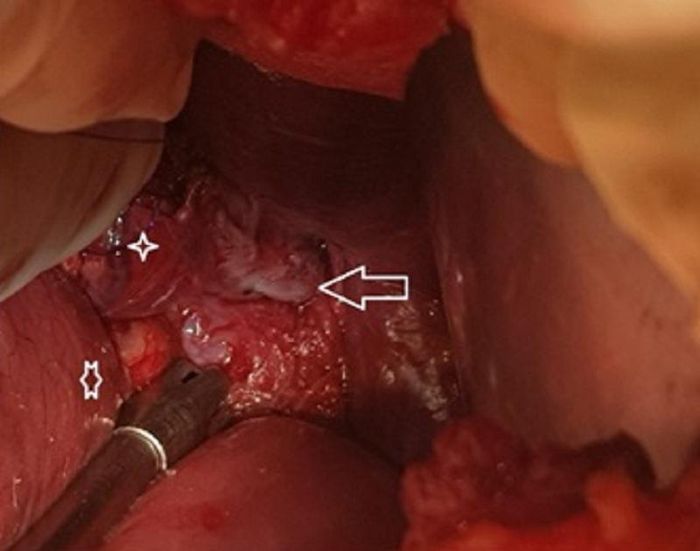 Vị trí thực quản bị vỡ của bệnh nhân được bác sĩ phát hiện trên camera nội soi