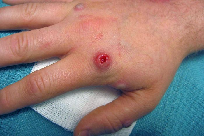 Vết phát ban mưng mủ đặc trưng của người mắc đậu mùa khỉ. Ảnh: CDC.