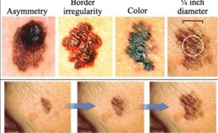 Các dấu hiệu cảnh báo ung thư da. Ảnh: Viện Ung thư Quốc gia và Tổ chức Ung thư da 