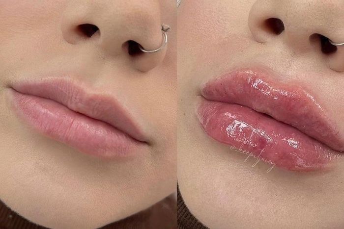 Nhiều người đang khoe ảnh trước và sau khi dùng bút làm đầy môi trên mạng xã hội. Ảnh: keepytucy.