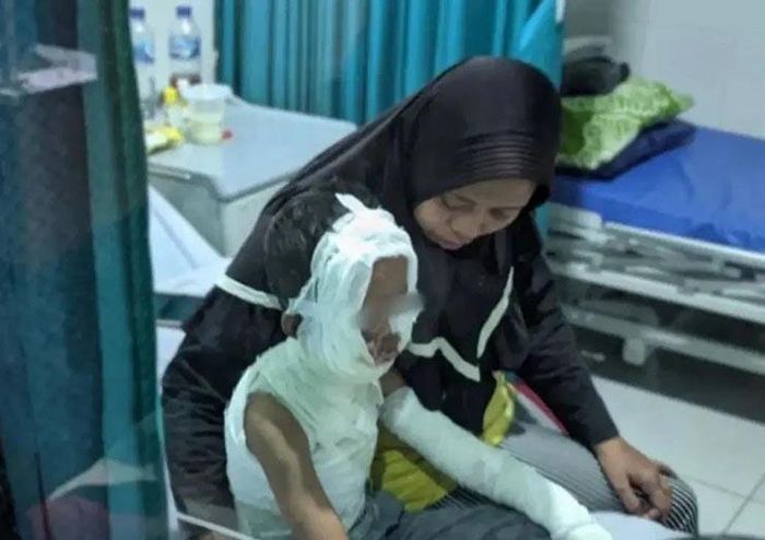 Cậu bé bị bỏng nặng ở mặt.