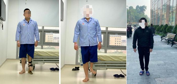 Nam bệnh nhân trước can thiệp phải mang giày chỉnh hình cao bằng gần gang tay, sau chỉnh sửa đã đi lại bình thường với hai chân cân bằng. 