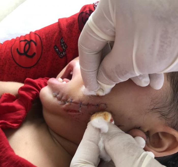 Cháu M. bị chó dạn tấn công hiện sức khỏe đã ổn định.