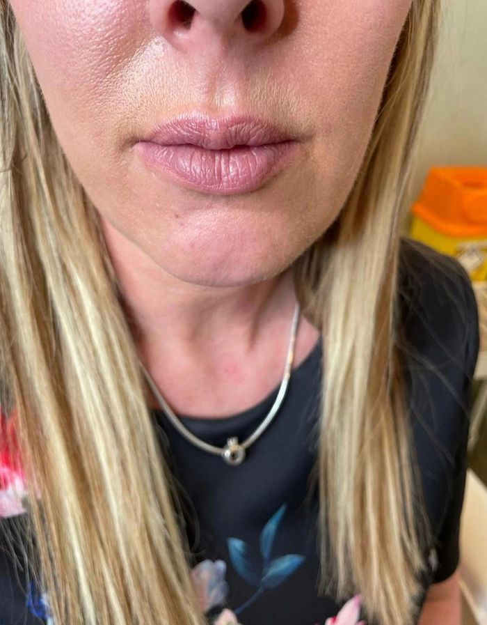 Môi của Emma Griffin bị sưng sau khi tiêm filler (ảnh trái). Cô mất gần 4 năm để đôi môi nhìn bình thường (ảnh phải). Ảnh: NYPost.