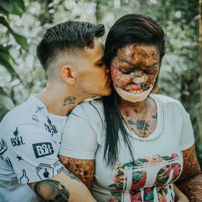 Edmilson yêu Karine bất chấp căn bệnh và những khiếm khuyết về ngoại hình của cô.