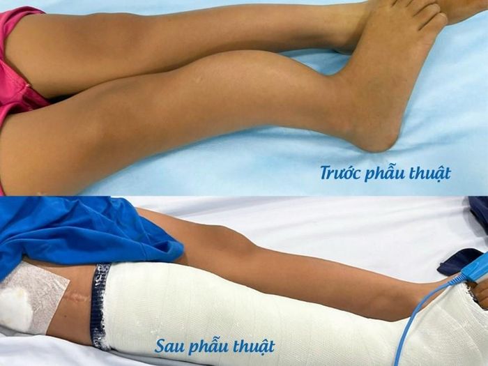Chân của em L. trước và sau phẫu thuật
