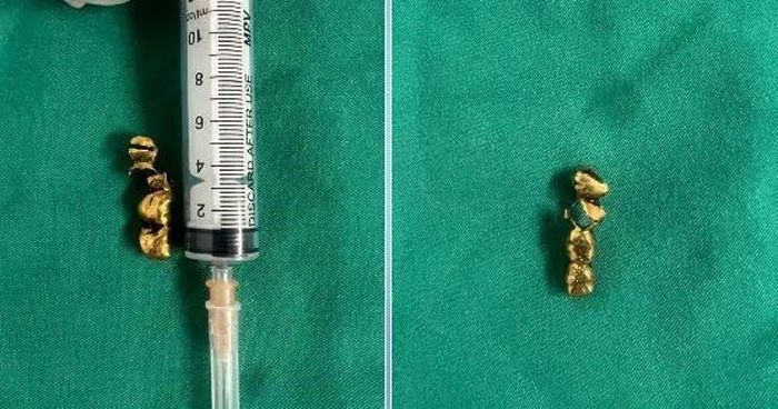 Chiếc răng giả được lấy ra. Ảnh: BVCC