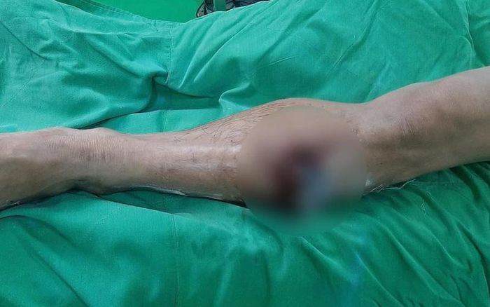 Bệnh nhân bị lưỡi cày găm vào chân trái khi đang cày ruộng. (Ảnh: BVCC)