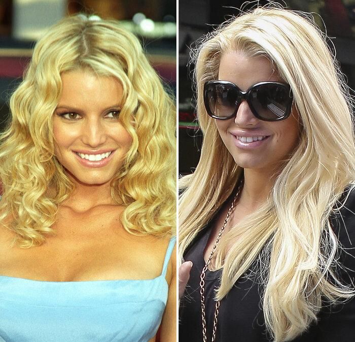 Mặc dù dính nghi án lạm dụng "dao kéo" đến mức cứng đơ gương mặt, tuy nhiên Jessica Simpson chỉ thừa nhận đã tiêm môi. Thủ thuật làm đẹp này cũng khiến cô hối hận vì khiến đôi môi của cô trông sưng tều, giả tạo.