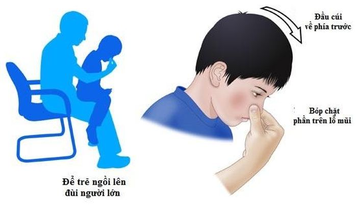  Cách sơ cứu cơ bản khi trẻ chảy máu cam. Ảnh: Rch. 