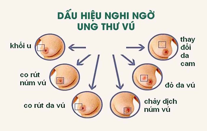 Các dấu hiệu ung thư vú