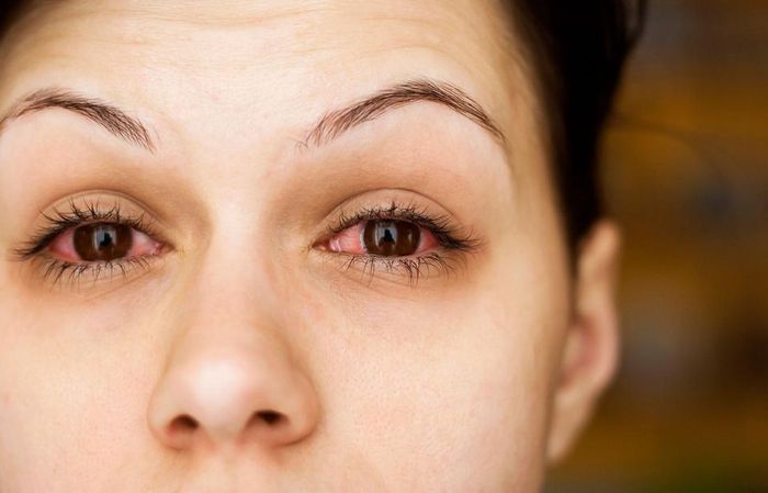 Hội chứng khô mắt là một vấn đề rất đáng quan tâm hiện nay. Ảnh: Bekahbrunstetter.