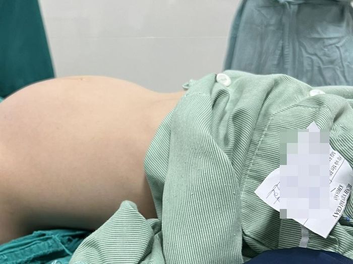  Khối u buồng trứng phát triển to trong ổ bụng của bé gái 12 tuổi. Ảnh: BVCC. 