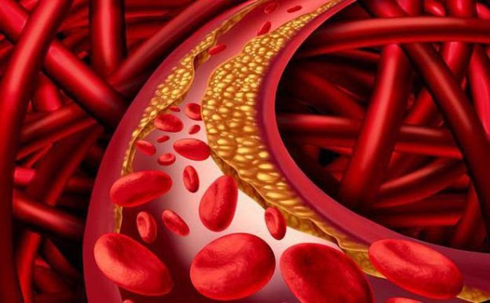 Các thuốc statin giúp hạ cholesterol có thể làm giảm nguy cơ đột quỵ.