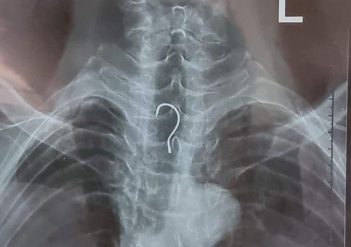 Lưỡi câu mắc trong thực quản bệnh nhân. (Ảnh: Bệnh viện cung cấp).