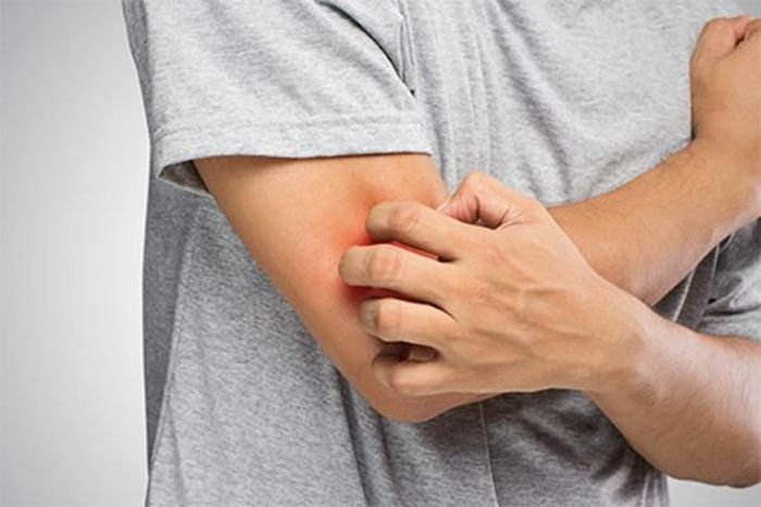 Ngứa, vàng da có liên quan tới nhiều loại bệnh. Ảnh minh họa: Cancerconnect