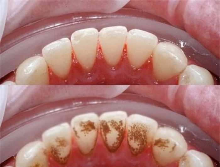 Bạn có thể làm trắng răng tại nhà bằng lá húng quế.