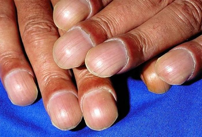 Ảnh minh họa: Medicinenet