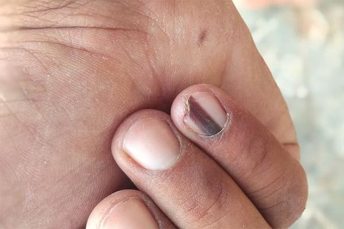 Vạch đỏ kéo dài ở móng tay có thể liên quan tới bệnh tim. Ảnh minh họa: Nailpro