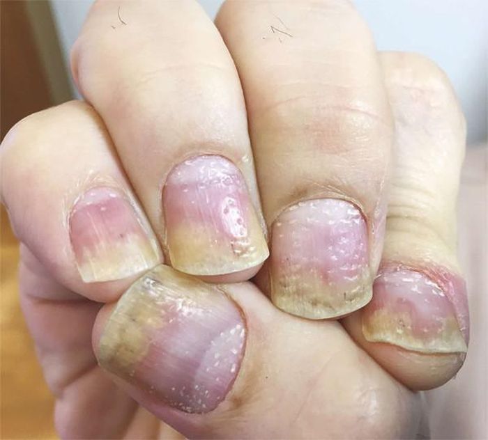 Viêm khớp vẩy nến có thể bộc lộ dấu hiệu ở móng tay. Ảnh minh họa: Health