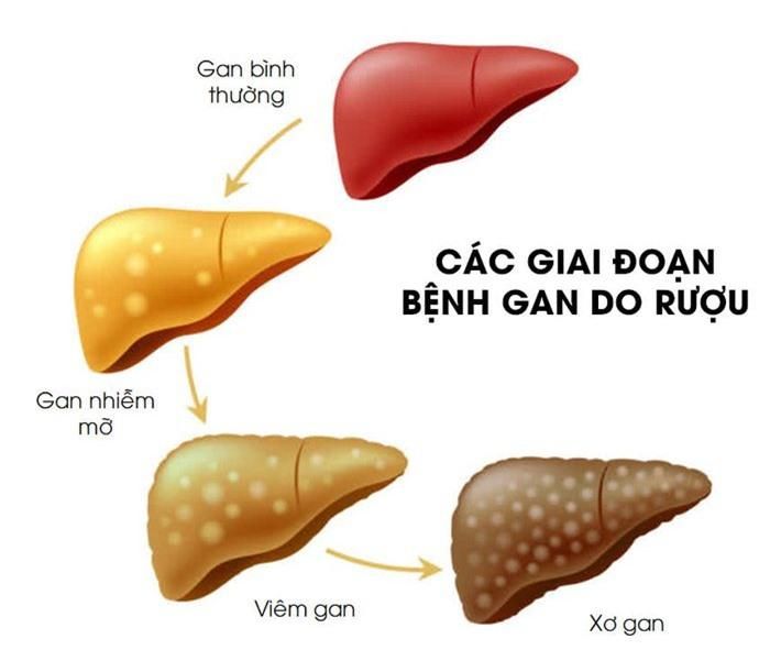 Sử dụng rượu bia thường xuyên sẽ làm gia tăng các bệnh lý về gan (Ảnh: Internet)