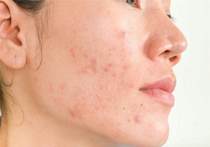 Rau kinh giới có thể giúp giảm mụn, làm trắng da.