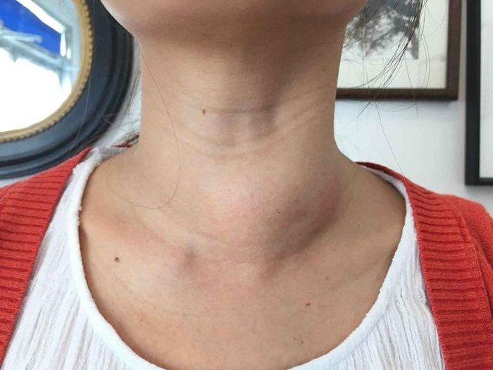 Có nhiều nguyên nhân gây ra bướu cổ như chế độ ăn thiếu i-ốt, ung thư tuyến giáp hoặc viêm tuyến giáp.