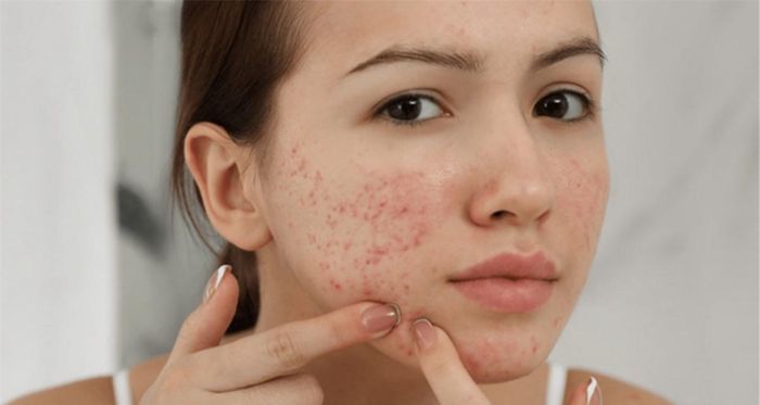 Làm dịu những đốm mụn trên da: Nếu cảm thấy khó chịu với những nốt mụn sưng đỏ, hãy chườm đá lạnh lên vùng da đó hoặc đặt trực tiếp lên nốt mụn đó. Đa lạnh sẽgiúp giảm đau và chống sưng tẩy do mụn gây ra. Ảnh minh họa