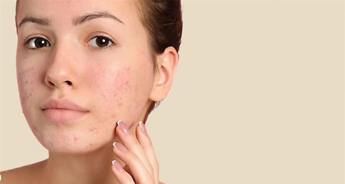 Làm se khít lỗ chân lông: Lỗ chân lông to khiến bụi bẩn, bã nhờn tích tụ lâu ngày sẽ hình thành mụn. Sau khi rửa mặt,massage bằng đá lạnh sẽ giúp se khít các lỗ chân lông, da sẽ sạch và mịn mànghơn. Ảnh minh họa