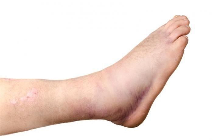 Bong gân là tình trạng kéo giãn hoặc rách dây chằng – một dải mô sợi chắc khỏe nối hai xương với nhau. Nguồn ảnh: Internet