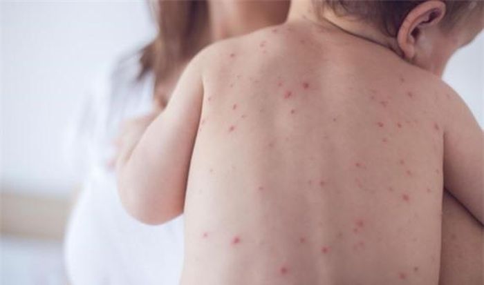 Bệnh thủy đậu là một bệnh nhiễm trùng do virus varicella-zoster gây ra. Nguồn ảnh: Internet.